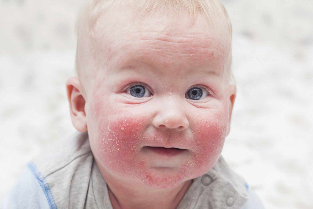 Baby Advice Websites Offer Help for Dealing with Eczema