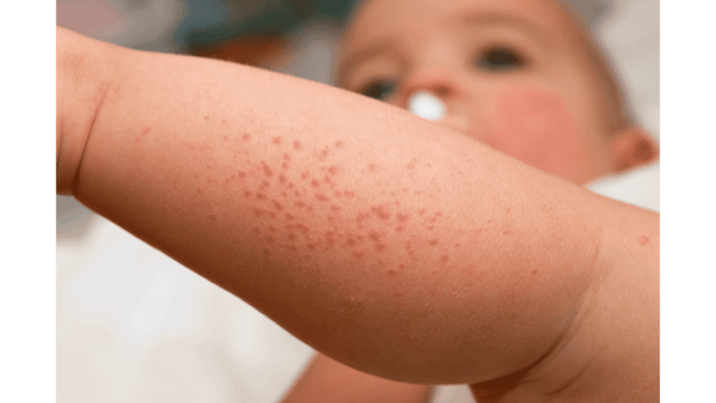 Baby-milk-bath-for-eczema